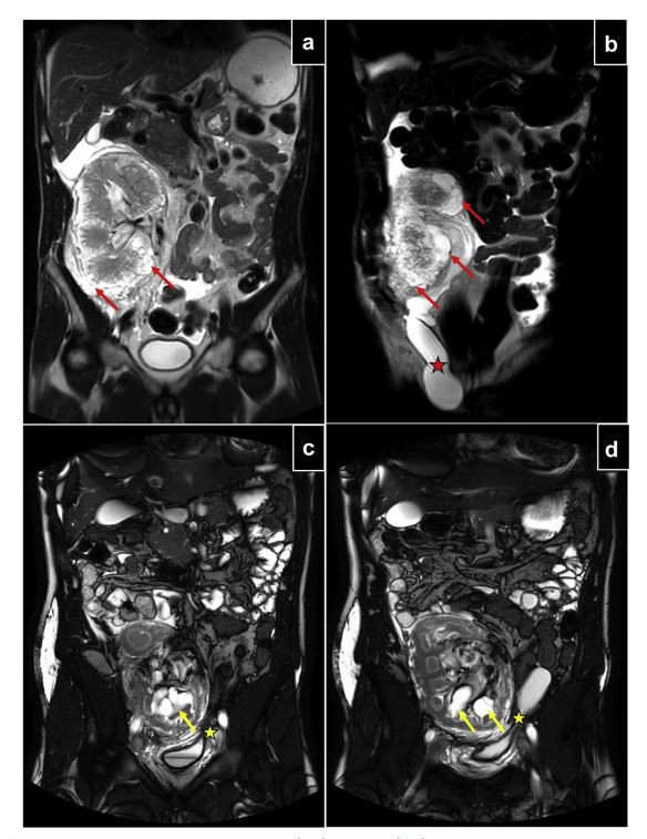 Figure 1. MR-urography findings regarding patient 1 and patient 2. (a,b) Patient 1 Figure 1. MR-urography findings regarding patient 1 and patient 2. (a,b) Patient 1