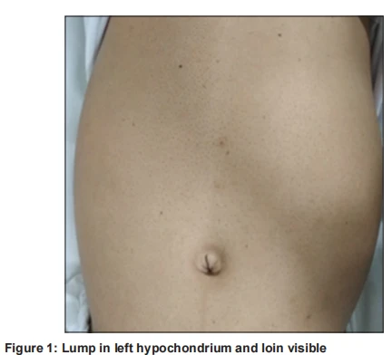Lump in left hypochondrium and loin visible Lump in left hypochondrium and loin visible