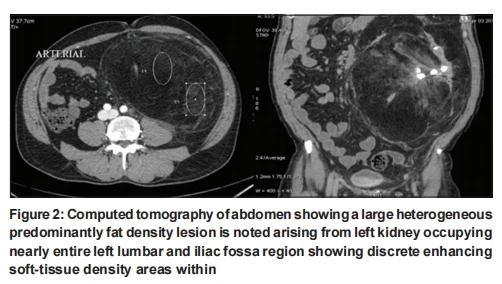 Computed tomography of abdomen showing a large heterogeneous predominantly fat density lesion is noted arising from left kidney occupying nearly entire left lumbar and iliac fossa region showing discrete enhancing soft‑tissue density areas within Computed tomography of abdomen showing a large heterogeneous predominantly fat density lesion is noted arising from left kidney occupying nearly entire left lumbar and iliac fossa region showing discrete enhancing soft‑tissue density areas within