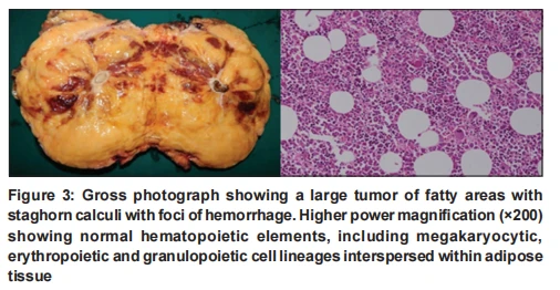 Gross photograph showing a large tumor of fatty areas with staghorn calculi with foci of hemorrhage. Higher power magnification (×200) showing normal hematopoietic elements, including megakaryocytic, erythropoietic and granulopoietic cell lineages interspersed within adipose tissue Gross photograph showing a large tumor of fatty areas with staghorn calculi with foci of hemorrhage. Higher power magnification (×200) showing normal hematopoietic elements, including megakaryocytic, erythropoietic and granulopoietic cell lineages interspersed within adipose tissue